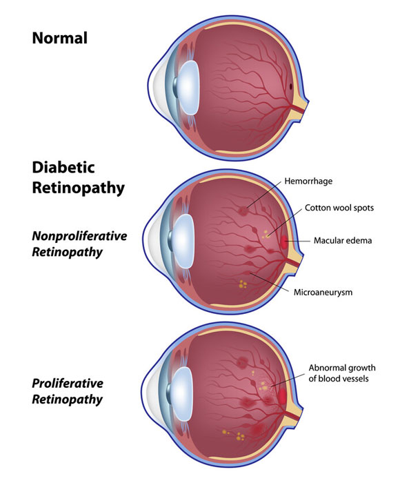 Diabetes-and-your-eyes