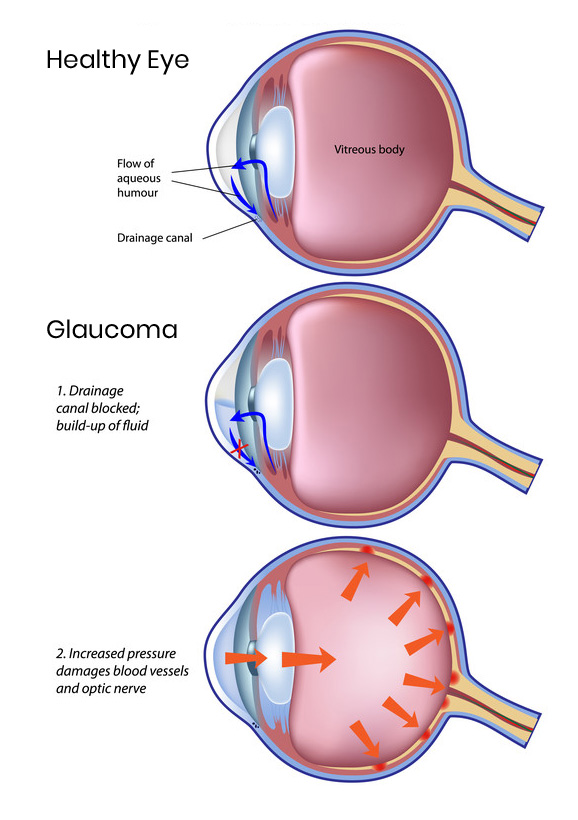 Glaucoma treatment