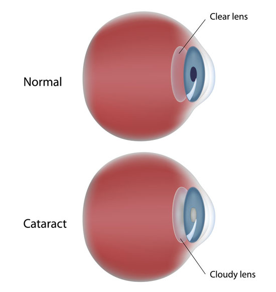 Signs of Cataracts